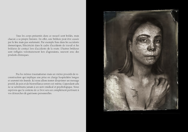 Clément Marion Brûlés Clélia LeBreton livre grands brûlés